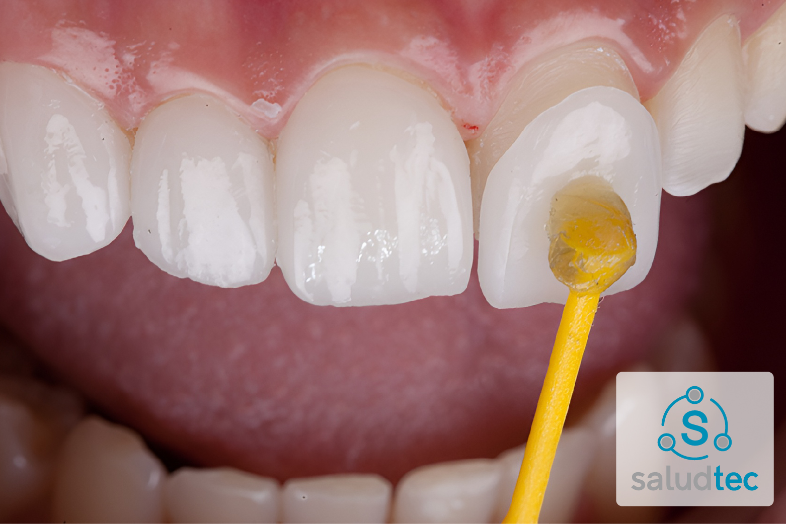 Carillas Dentales y Odontología Digital: La Combinación Perfecta para tu consulta.