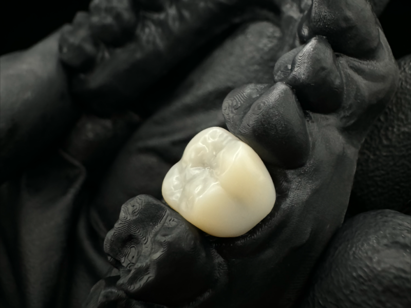 molar en ceramica crown
